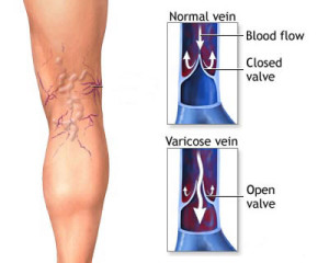 varicose-veins - Cardiac Associates, P.C.